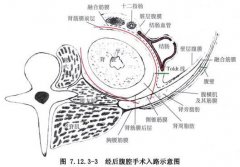重庆龙湖医院腹膜后腹腔镜肾囊肿去顶术