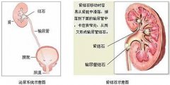 重庆龙湖医院专家浅析肾结石症理解几大误区