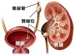 重庆龙湖医院钬激光碎石术